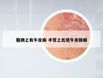 胳膊上有牛皮癣 手臂上出现牛皮肤癣