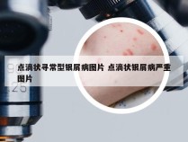 点滴状寻常型银屑病图片 点滴状银屑病严重图片