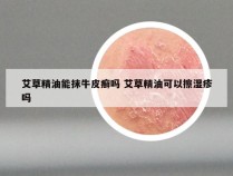 艾草精油能抹牛皮癣吗 艾草精油可以擦湿疹吗