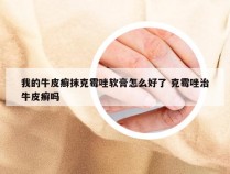 我的牛皮癣抹克霉唑软膏怎么好了 克霉唑治牛皮癣吗