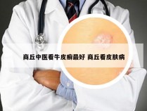 商丘中医看牛皮癣最好 商丘看皮肤病