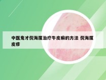 中医鬼才倪海厦治疗牛皮癣的方法 倪海厦 皮疹