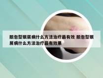 脓包型银屑病什么方法治疗最有效 脓包型银屑病什么方法治疗最有效果