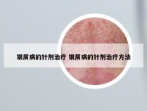 银屑病的针剂治疗 银屑病的针剂治疗方法