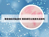 银屑病白印能激光 银屑病可以用激光去除吗