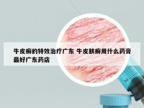 牛皮癣的特效治疗广东 牛皮肤癣用什么药膏最好广东药店