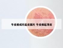 牛皮癣成片起皮图片 牛皮癣起薄皮