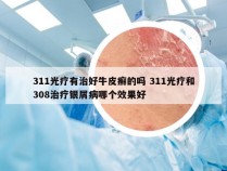 311光疗有治好牛皮癣的吗 311光疗和308治疗银屑病哪个效果好