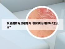 银屑病有办法根除吗 银屑病治得好吗?怎么治?