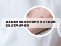 身上有银屑病能给宝宝喂奶吗 身上有银屑病能给宝宝喂奶吗视频