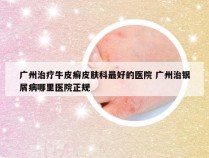 广州治疗牛皮癣皮肤科最好的医院 广州治银屑病哪里医院正规