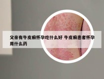 父亲有牛皮癣怀孕吃什么好 牛皮癣患者怀孕用什么药