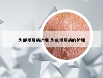 头部银屑病护理 头皮银屑病的护理