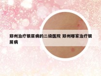 郑州治疗银屑病的二级医院 郑州哪家治疗银屑病