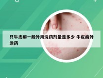 只牛皮癣一般外用洗药剂量是多少 牛皮癣外涂药
