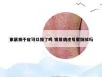 银屑病干皮可以撕了吗 银屑病皮屑要撕掉吗