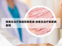 修美乐治疗脓疱型银屑病 修美乐治疗银屑病原理