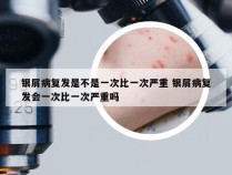银屑病复发是不是一次比一次严重 银屑病复发会一次比一次严重吗
