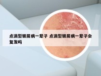 点滴型银屑病一辈子 点滴型银屑病一辈子会复发吗