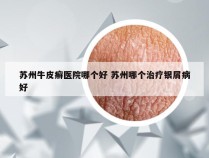苏州牛皮癣医院哪个好 苏州哪个治疗银屑病好