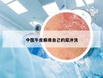 中医牛皮癣用自己的尿冲洗