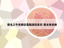 眉毛上牛皮癣还是脂溢性皮炎 眉毛有皮癣
