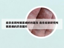 南京皮研所银屑病好的医生 南京皮肤研究所银屑病的药膏图片