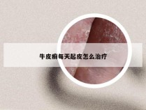 牛皮癣每天起皮怎么治疗