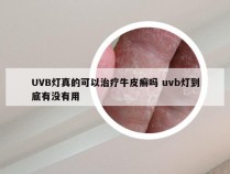 UVB灯真的可以治疗牛皮癣吗 uvb灯到底有没有用
