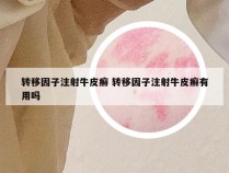 转移因子注射牛皮癣 转移因子注射牛皮癣有用吗