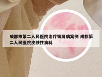 成都市第二人民医院治疗银屑病案例 成都第二人民医院皮肤性病科