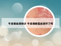 牛皮癣血液缺少 牛皮病癣是血液坏了吗