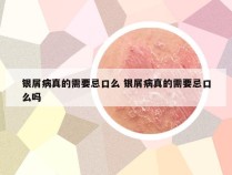 银屑病真的需要忌口么 银屑病真的需要忌口么吗