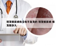 初发银屑病有没有不复发的 初发银屑病 爆发期多久