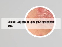 维生素b6对银屑病 维生素b6对湿疹有效果吗