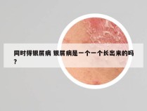 同时得银屑病 银屑病是一个一个长出来的吗?