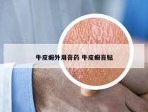牛皮癣外用膏药 牛皮癣膏贴