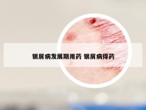 银屑病发展期用药 银屑病得药