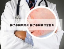 得了手癣的图片 得了手癣要注意什么