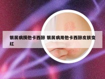 银屑病摸他卡西醇 银屑病用他卡西醇皮肤变红