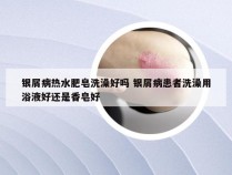 银屑病热水肥皂洗澡好吗 银屑病患者洗澡用浴液好还是香皂好