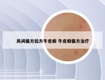 民间偏方验方牛皮癣 牛皮癣偏方治疗