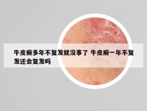 牛皮癣多年不复发就没事了 牛皮癣一年不复发还会复发吗