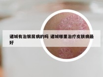 诸城有治银屑病的吗 诸城哪里治疗皮肤病最好