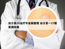 白介素18治疗牛皮癣原理 白介素一17银屑病效果