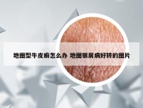 地图型牛皮癣怎么办 地图银屑病好转的图片