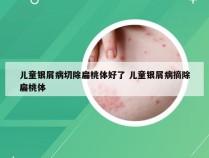 儿童银屑病切除扁桃体好了 儿童银屑病摘除扁桃体