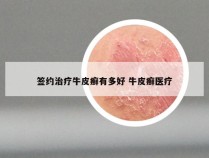 签约治疗牛皮癣有多好 牛皮癣医疗