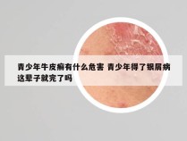 青少年牛皮癣有什么危害 青少年得了银屑病这辈子就完了吗