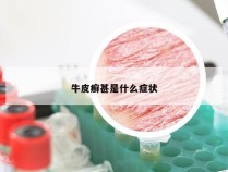 牛皮癣甚是什么症状